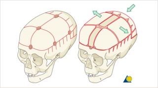 Demonstration of the bony cuts of a total cranial vault reshaping