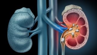 Kidney and kidney stone illustration