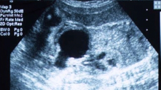 luto ultrasound