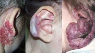 Ear Hemangiomas Image