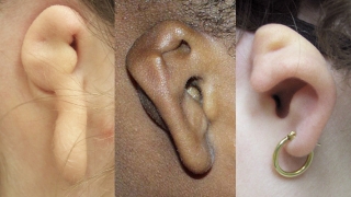 Ear Microtia Image