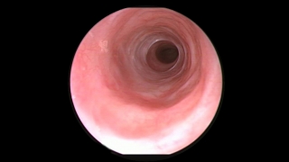 endoscopic view of tracheal rings