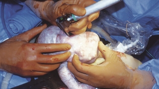 EXIT procedure with laryngoscopy