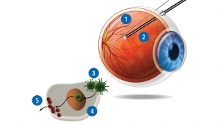 Diagram illustrating gene therapy for inherited blindness