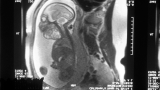 fetal MRI of cervical teratoma