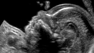 high-resolution fetal ultrasound