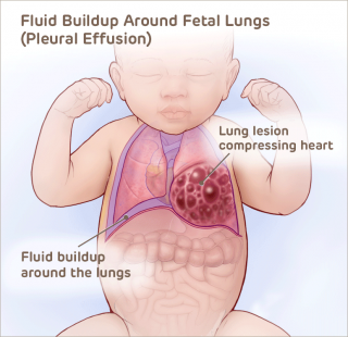 Fluid buildup around fetal lungs illustration