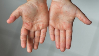 hand with hand foot and mouth disease