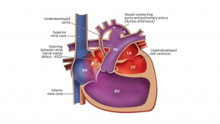 Hypoplastic Left Heart Syndrome Heart Illustration