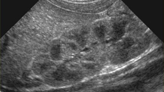 kidney ultrasound