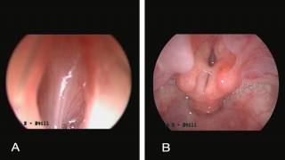 laryngeal atresia endoscopic view