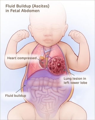 Fluid buildup (ascites) in the fetal abdomen caused by compression of the heart.