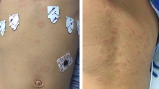 Annular plaques on the torso and back of a patient with MIS-C