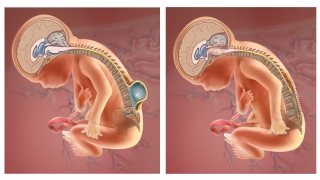 Fetus with myelomeningocele before and after prenatal spina bifida repair