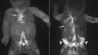 MRIs showing dynamic contrast MR lymphangiography (DCMRL) in neonatal chylothorax and CLFD