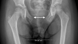 X-ray image of separation of the pubic rami