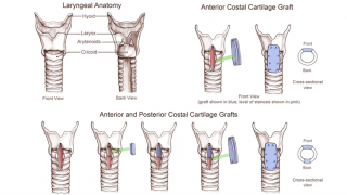 Laryngotracheoplasty - Thumbnail