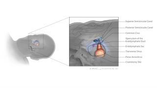 Vestibular schwannoma - skull head composite - Thumbnail