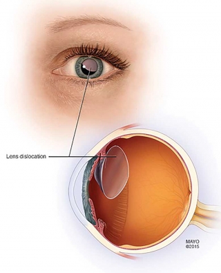 Pediatric Aphakia And Where To Place An Intraocular Lens - Figure 5
