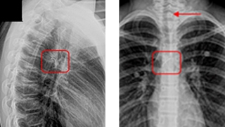 plain chest radiograph