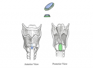 posterior costal cartilage graft