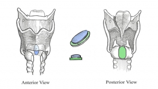 sutureless posterior graft