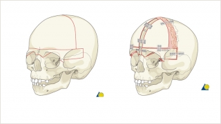 Demonstration of the bony cuts of a bilateral frontal orbital advancement and broadening