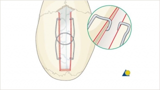Procedure demonstration of sagittal spring placement