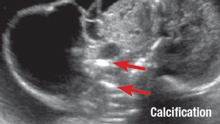 Sagittal image of a large cervical teratoma