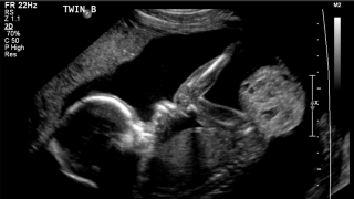 Ultrasound of a fetal sacrococcygeal teratoma