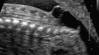 fetal ultrasound myelomeningocele