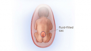 Illustration of fluid filled sac