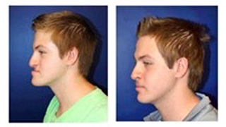 Jaw patient surgery before and after photos