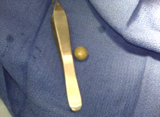 removed scrotal mass