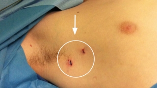 thorascopic sympathectomy incisions