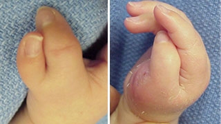 Thumb duplication, Wassel stage IV. 