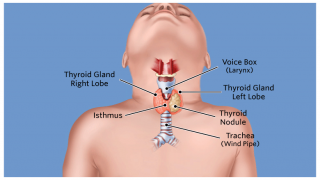 Thyroid Nodule Illustration