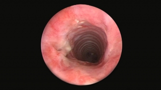 endoscopic view of tracheal stenosis after balloon dilation