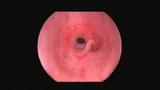 endoscopic view of tracheal stenosis