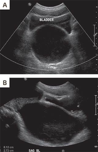 Transverse Vaginal Septum Cause of Urinary Retention Ultrasound