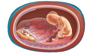 Illustration showing unequal blood flow of placenta in twins with TTTS