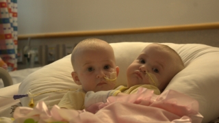 Tucker twins prior to surgery