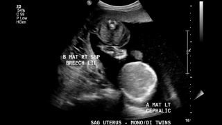 TTTS ultrasound