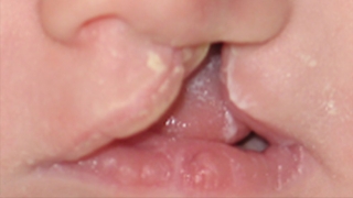 Van Der Woude - cleft lip and palate patient