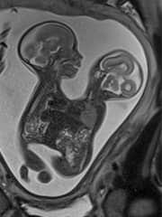 MRI image of conjoined twins