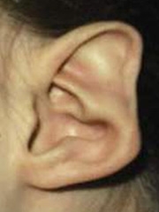 Stahl's Ear Image