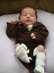 Elise as baby wearing pavlik harness
