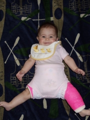 Elise as baby wearing hip cast smiling at camera