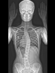X-ray of free bone age posture for scoliosis patients