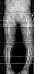 Figure 1: Pretreatment X-ray findings include severe or asymmetric bowing, varus centered at the proximal tibia, medial/ posterior sloping of the proximal tibial epiphysis, metaphyseal beaking, and possibly a congenital bony bar. 